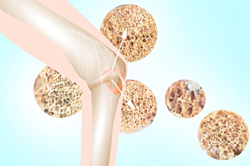 Multiple myeloma all you need to know