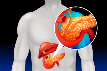 All you need to know about pancreatitis