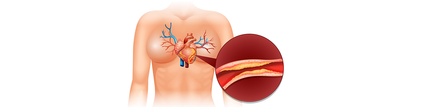 Coronary artery bypass graft surgery: Purpose, procedure and recovery