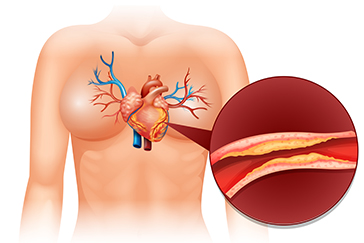 Coronary artery bypass graft surgery: Purpose, procedure and recovery
