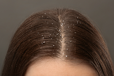 Snowflakes or dandruff flakes: Make your scalp healthier this winter