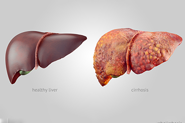 Cirrhosis: What is scarring your liver?