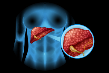 From abdominal pain to loss of appetite: Here are some symptoms that could be linked to gallbladder cancer