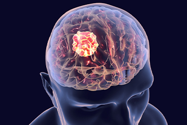 Brain tumour symptoms that should not be overlooked