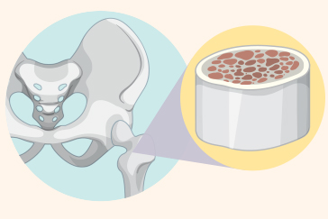 Understanding different types of bone marrow transplant