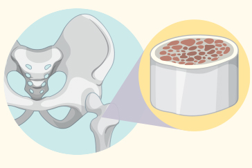 Busting some common myths about bone marrow transplant